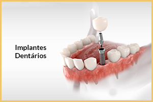 implantes dentarios turquia